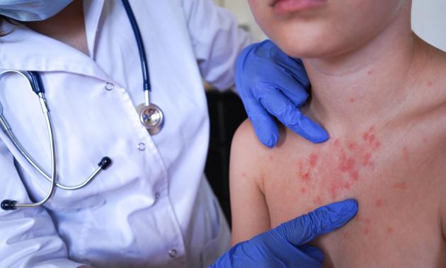 2 dead from measles in Pennsylvania. What's Franklin County situation?